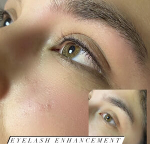 Eyelash Enhancement